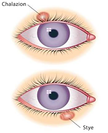 Labelled diagram showing the typical positions of a chalazion and a stye on the eyelid