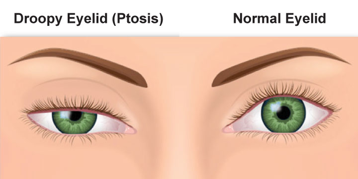 Illustration comparing a droopy upper eyelid with a normal eyelid position